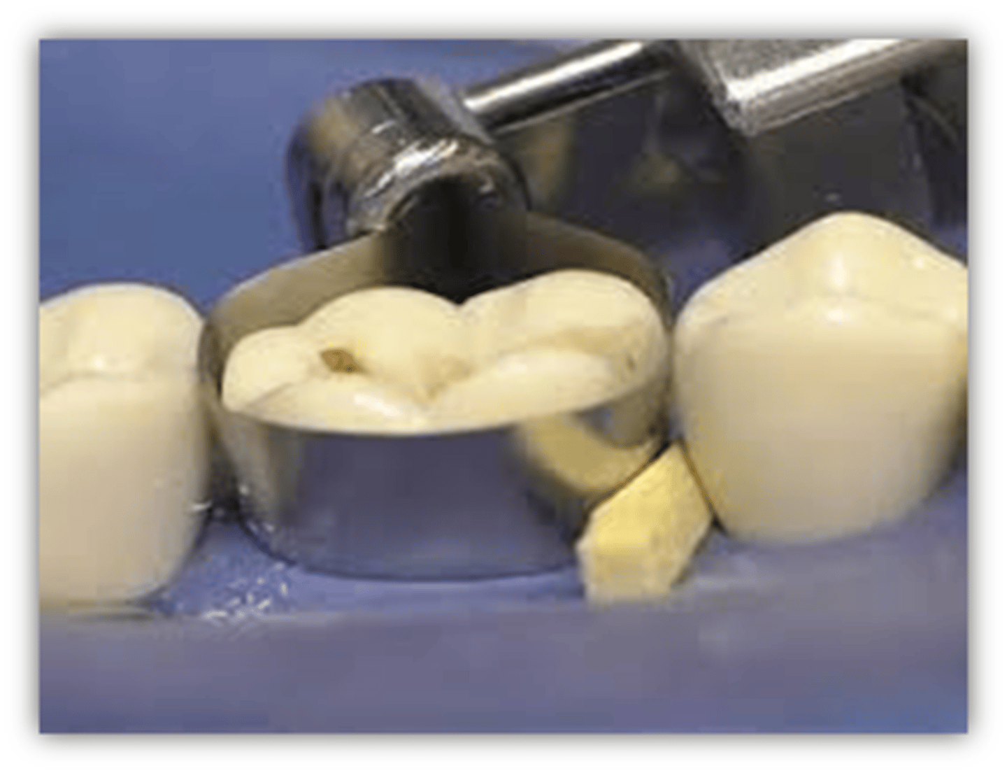 <p>secure the matrix band</p><p>interproximal contour/ contact</p>