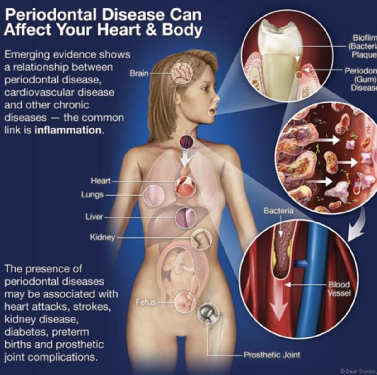 <p>presence of periodontal disease may be associated with heart attacks, strokes, kidney disease, diabetes etc.</p>