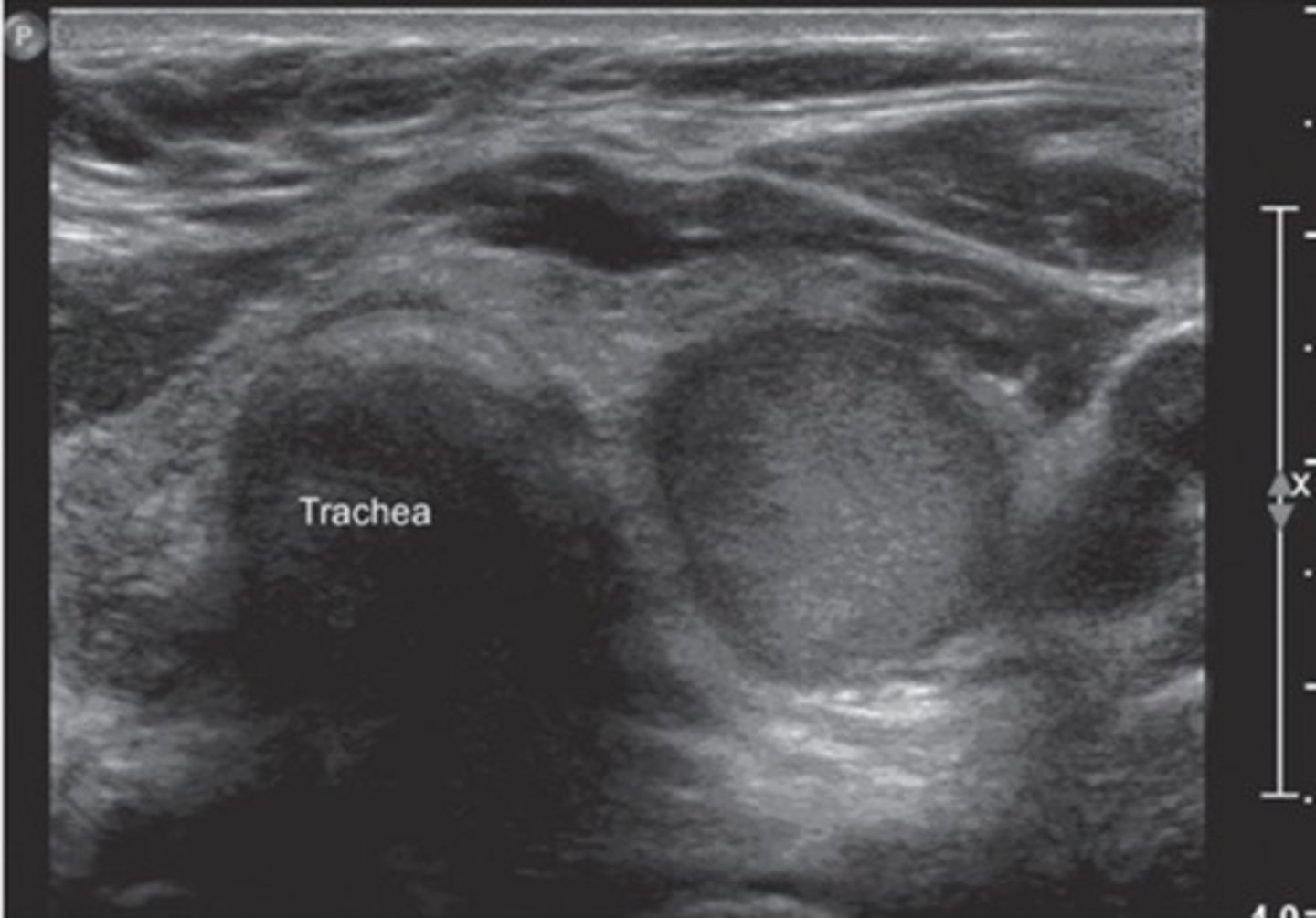 <p>Benign mass that results in hyperthyroidism</p>