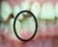 <p>tooth positioned toward tongue </p>