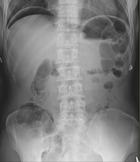 <p>Identify this pathology and describe the RA and symptoms</p>