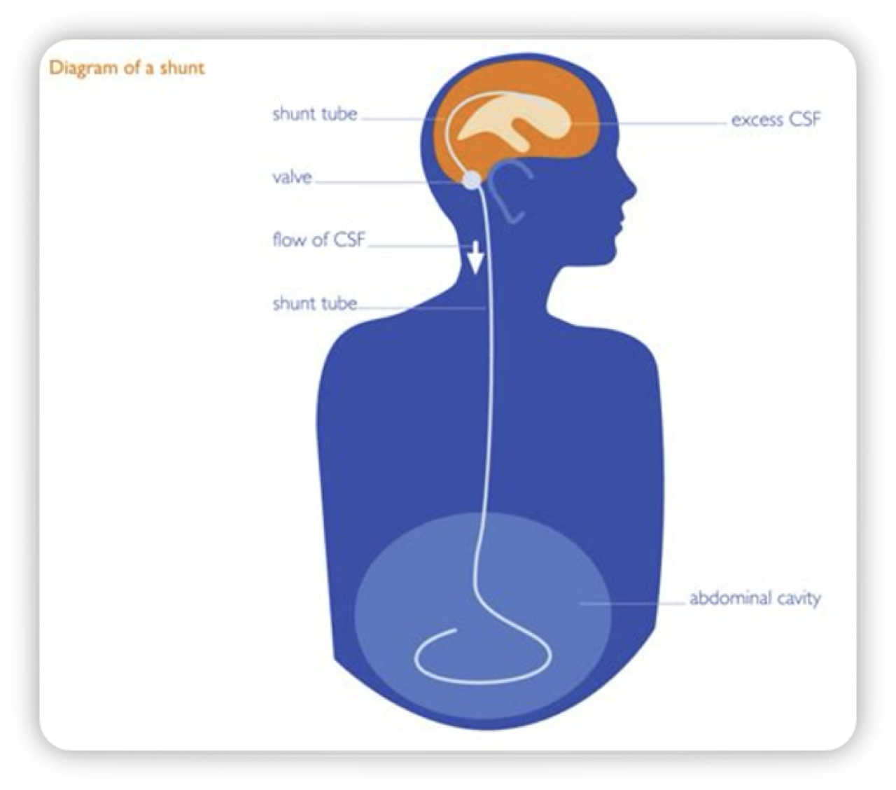 <p><span>Shunt = most common​</span></p><p class="p1"><span>​Complications:​</span></p><ul><li><p class="p1"><span>Infection​</span></p></li><li><p class="p1"><span>Obstruction​</span></p></li><li><p class="p1"><span>Revision with growth</span></p></li></ul><p></p>