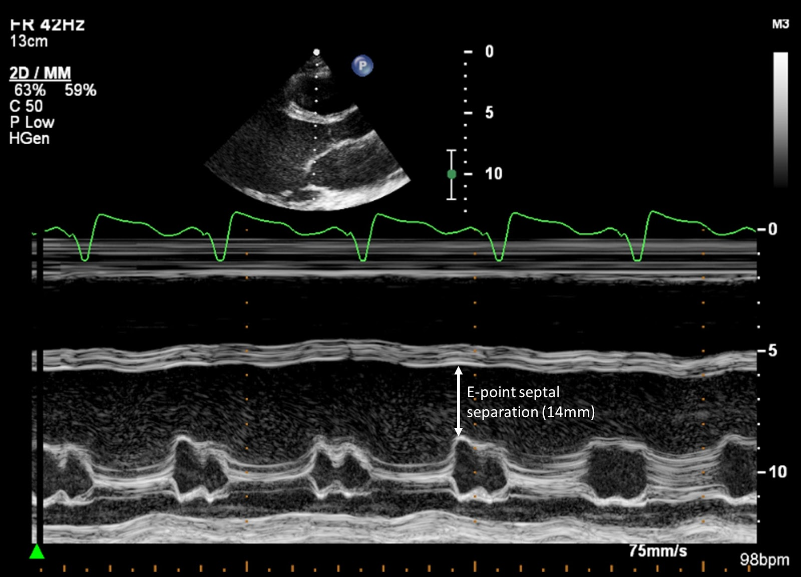 <p>What m-mode finding is seen on both aortic insufficiency and DCM?</p>
