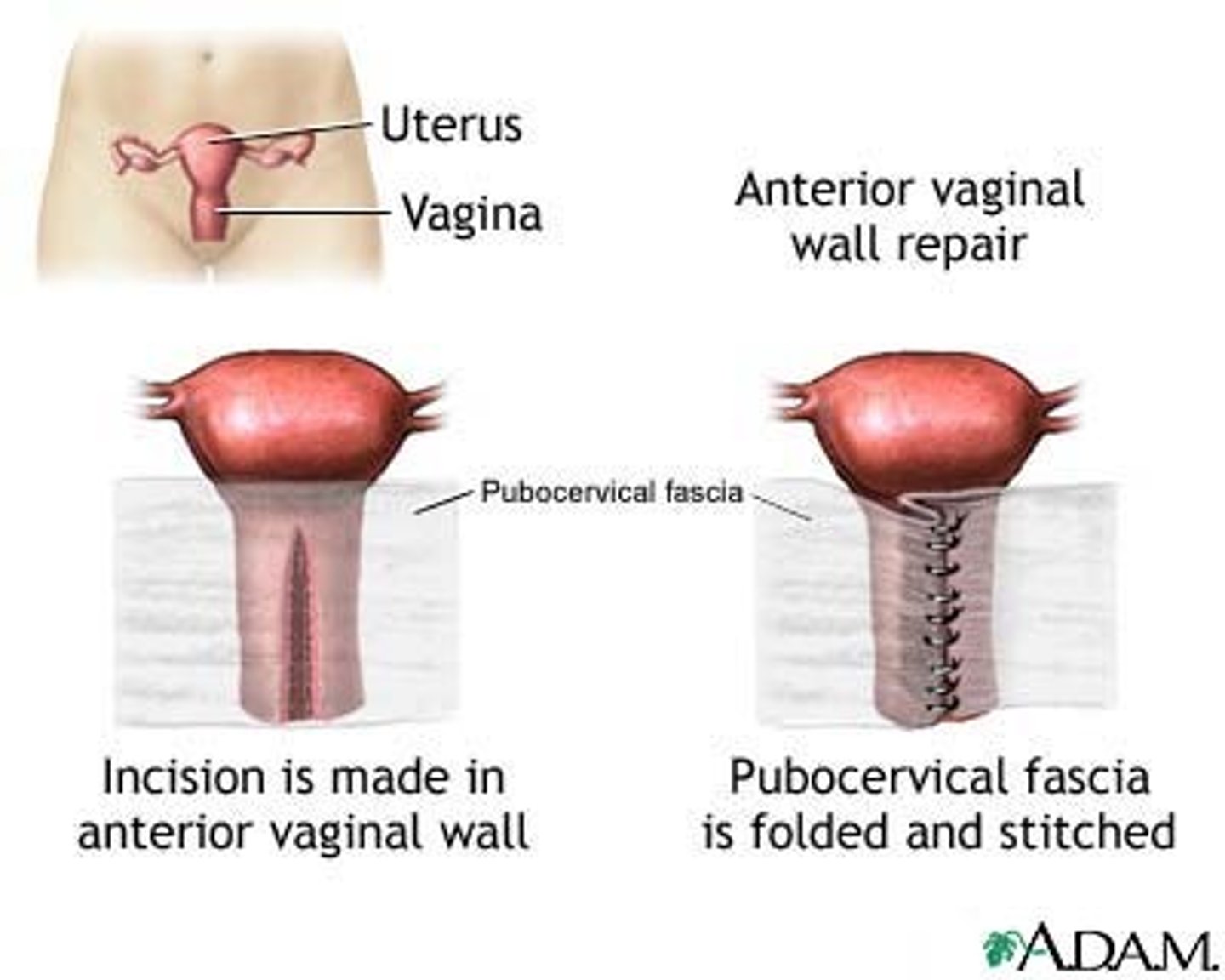 <p>suture of the vagina</p>