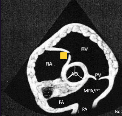 <p>Right Parasternal Short Axis View&nbsp;</p>