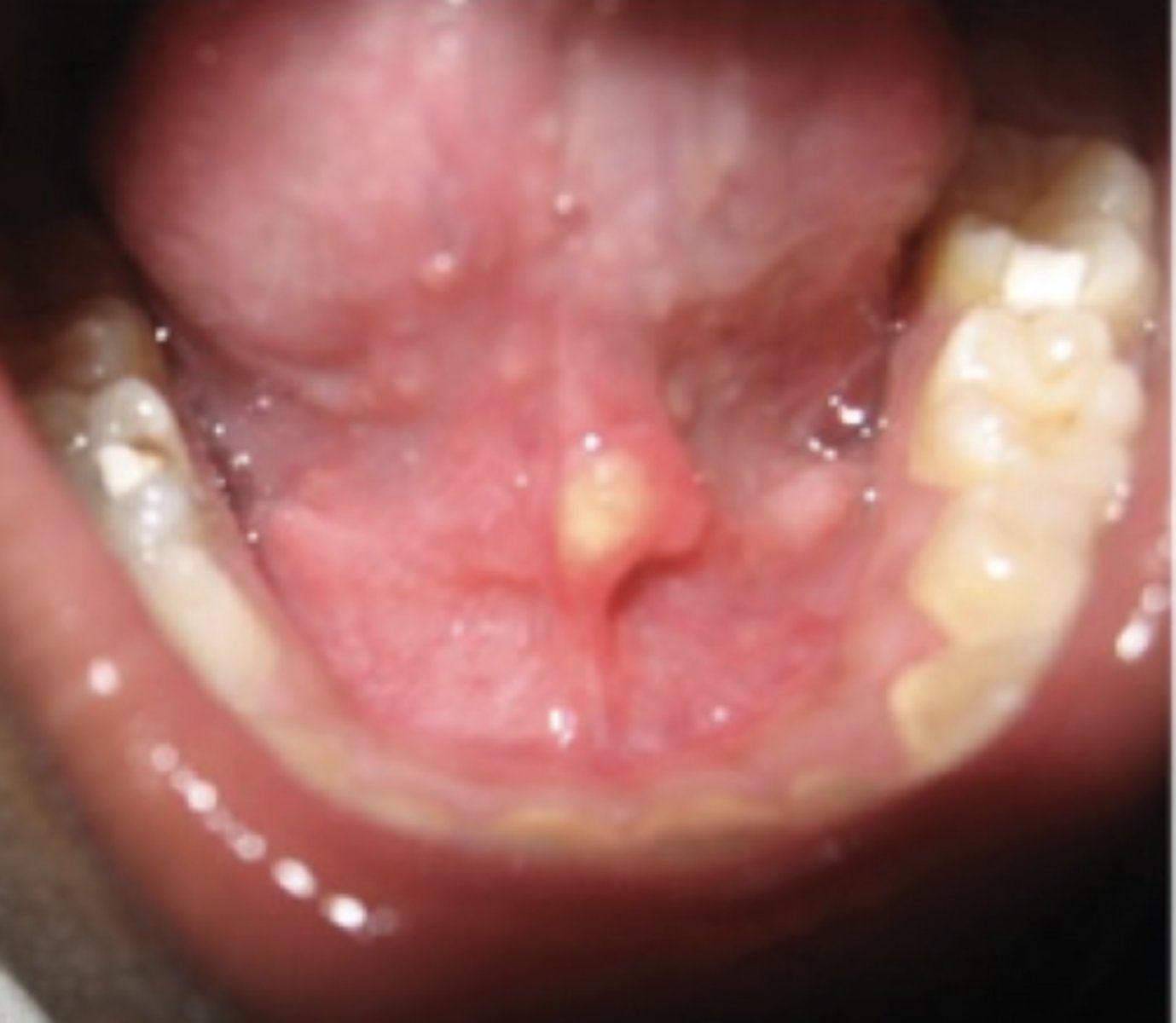 <p>Deposits of calcium salts in the salivary gland/ duct, Decreased salivary flow OR increased viscosity</p>