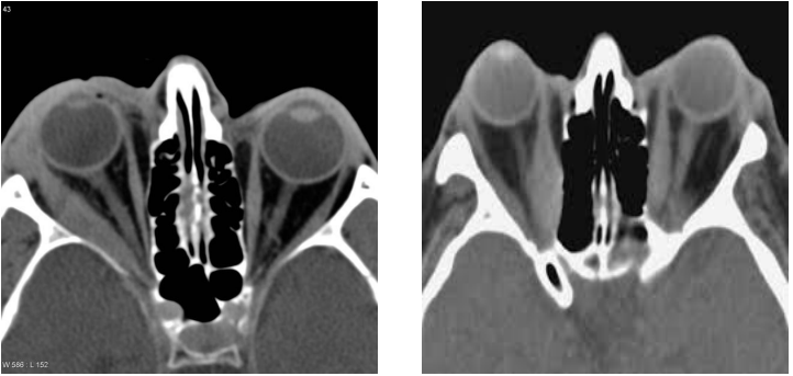 <p>which is Dacryoadenitis + Myositis and which is Thyroid ophthalmopathy </p>