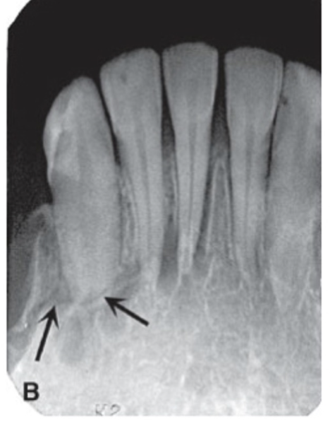 <p>radiolucent line travels through the bone</p>