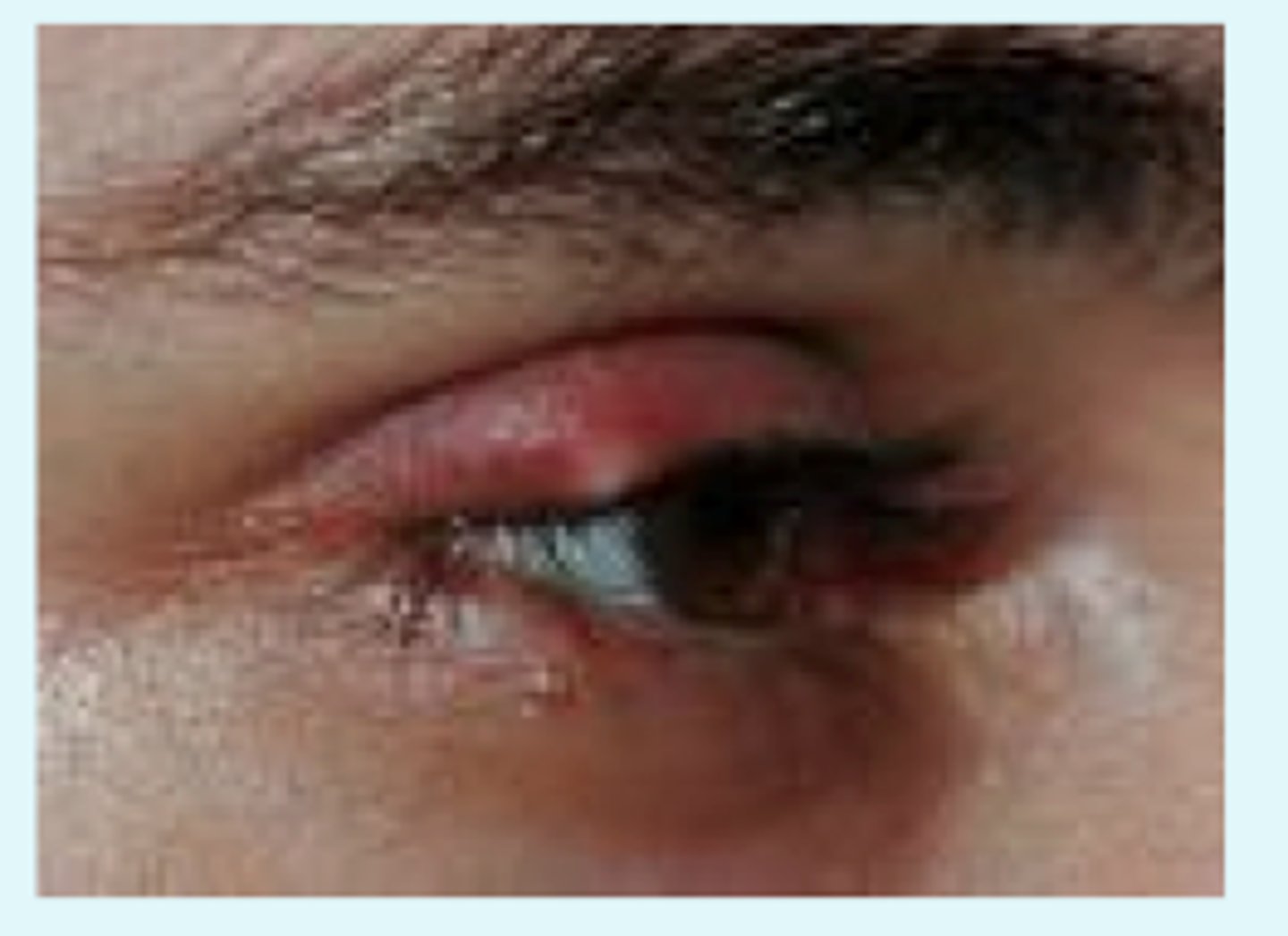 <p>Hordeolum</p><p>(different from a chalazion which is painless) Think "H" for Hot = Hordeolum</p>