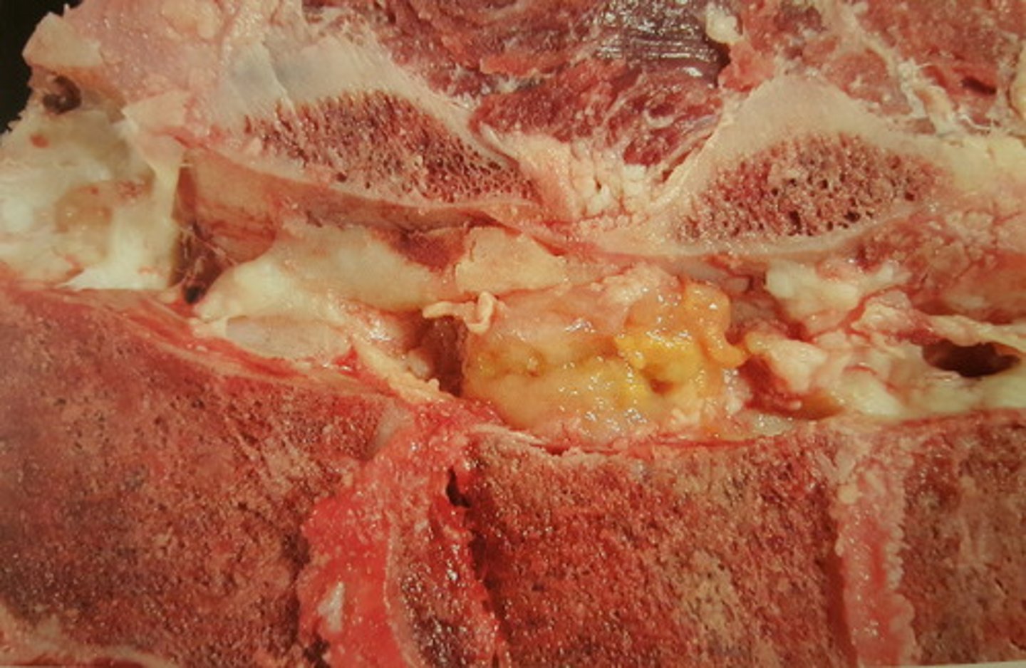 <p>Canalis vertebralis - okse. Patoanatomisk diagnose?</p>