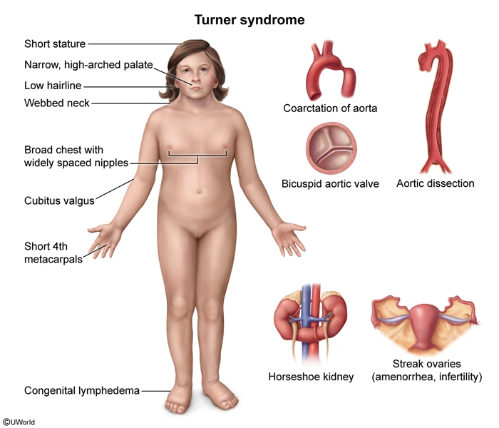 <p><strong>aortic dissection</strong>, horseshoe kidney, osteoporosis, strabismus, myopia, recurrent otitis media, celiac disease, hypothyroidism</p>