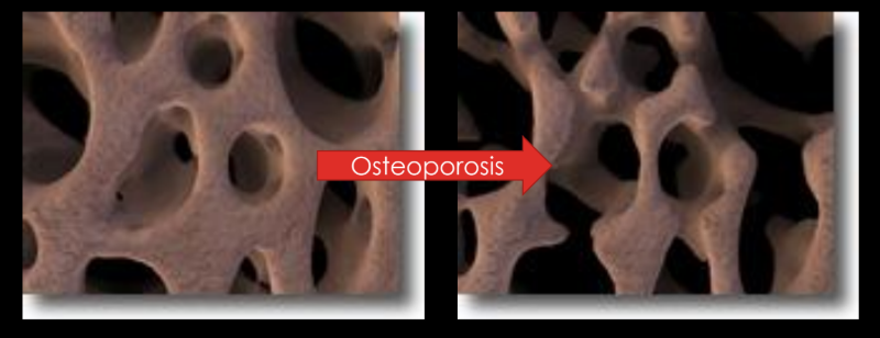 <p><span><span>cancellous</span></span></p><p><span><span>(Cancellous bone density declines more rapidly, especially in women after menopause due to accelerated bone turnover and loss of trabecular structure.)</span></span></p>