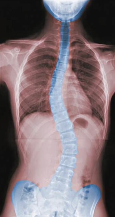<ul><li><p>abnormal lateral curvature</p></li></ul><p></p>