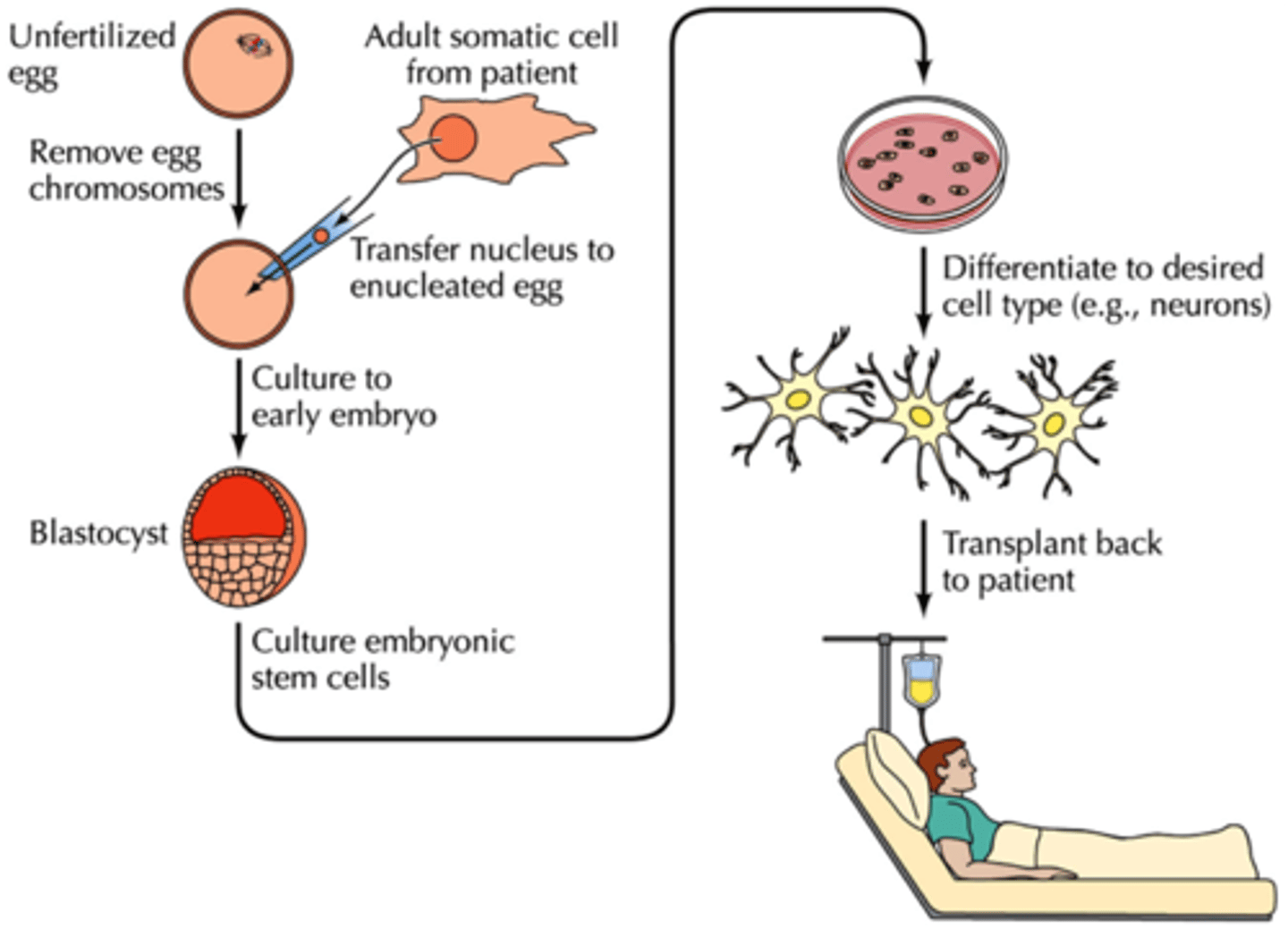 <p>When an embryo is produced with the same genes as the patient as a source of stem cells</p>