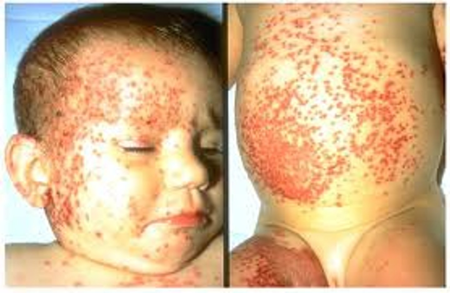 <p>Welke virale infectie is dit?</p>