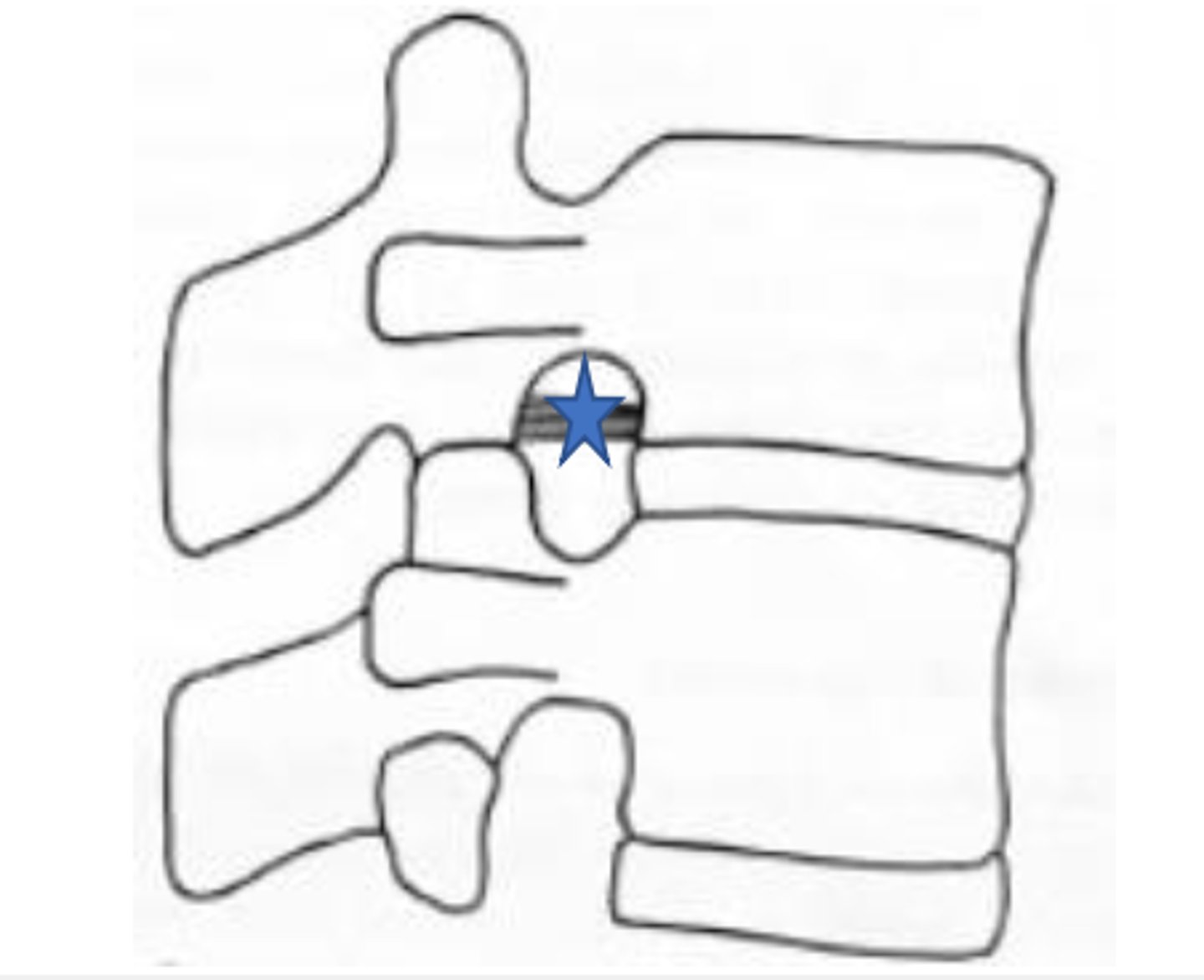 <p>superior transforaminal ligaments</p>