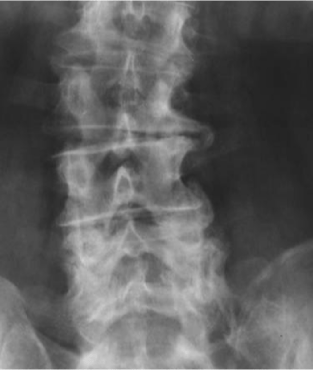 <p>ID complication of degenerative lumbar spine disease</p>