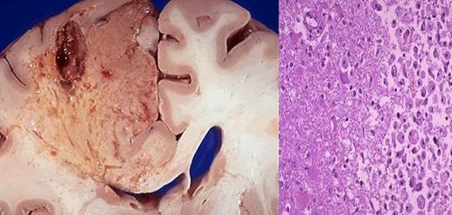 <p>Liquefactive necrosis of the brain</p>