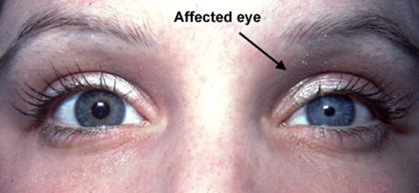 <p>Horner's syndrome</p>