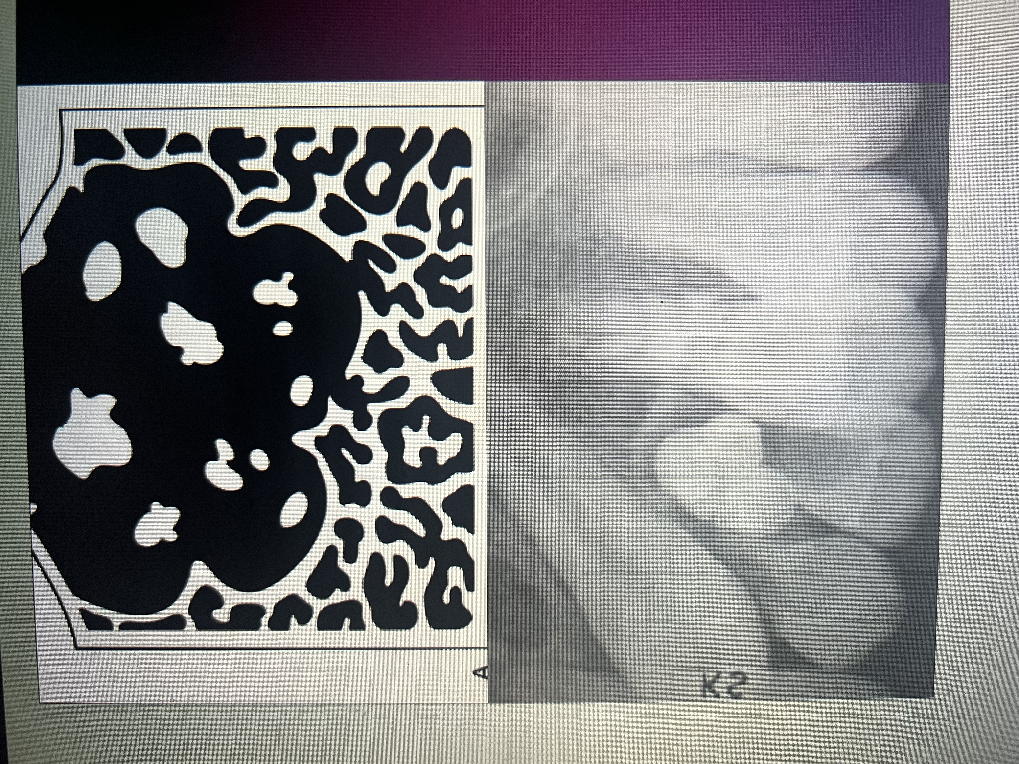 <p>Mixed lucent-opaque lesion</p>