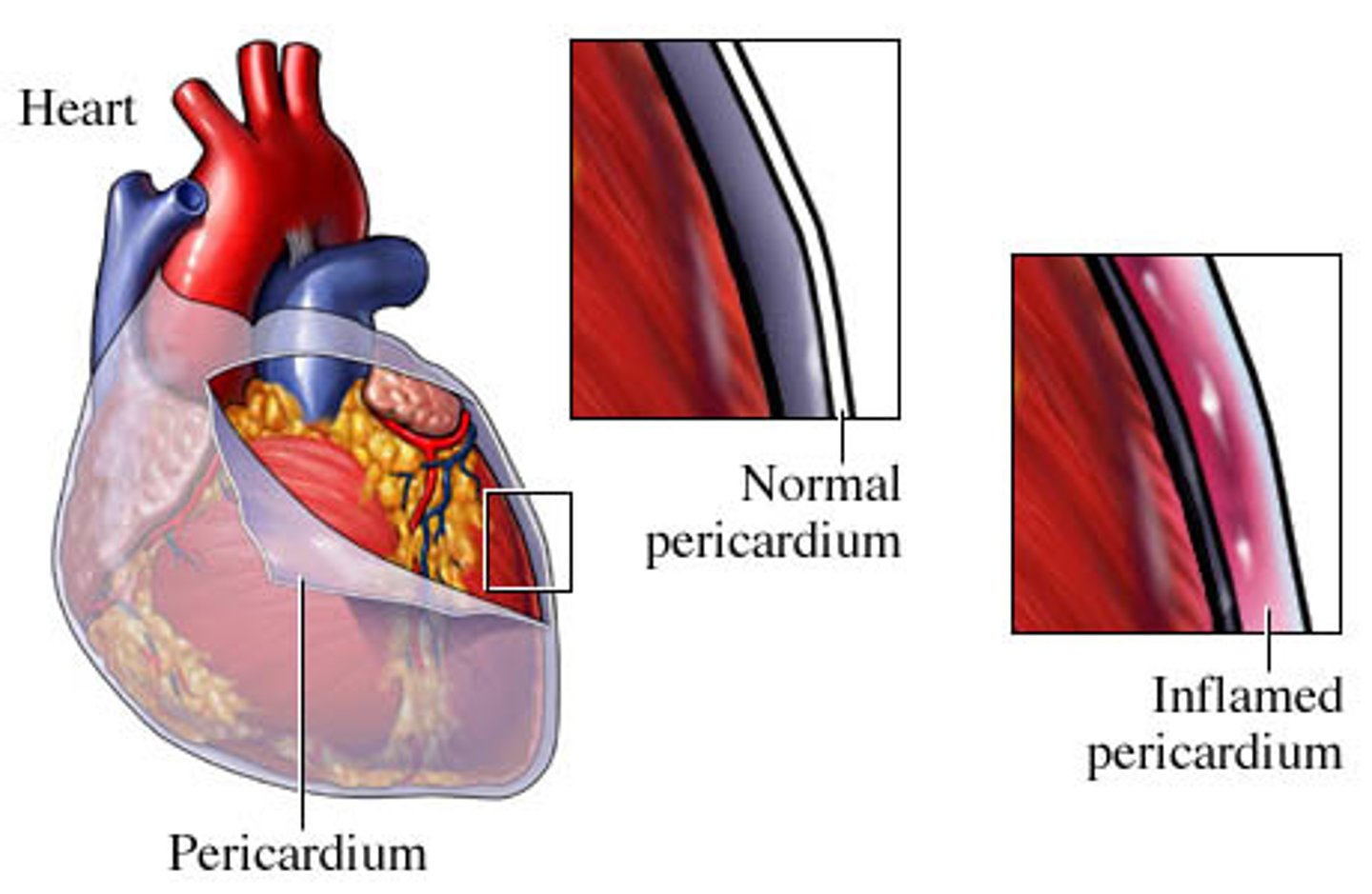 <p>inflammation of the pericardium; can be heard as friction rub during auscultation</p>