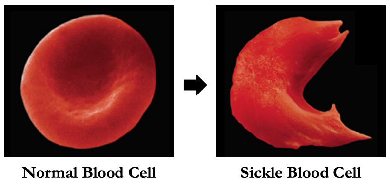 <ul><li><p>Alters haemoglobin structure → forms insoluble strands</p></li><li><p>Cannot transport oxygen effectively → causing fatigue</p></li><li><p>Red blood cells adopt a sickle shape → may form clots</p></li><li><p>Sickle cells are destroyed at a higher rate → anemia</p></li></ul>