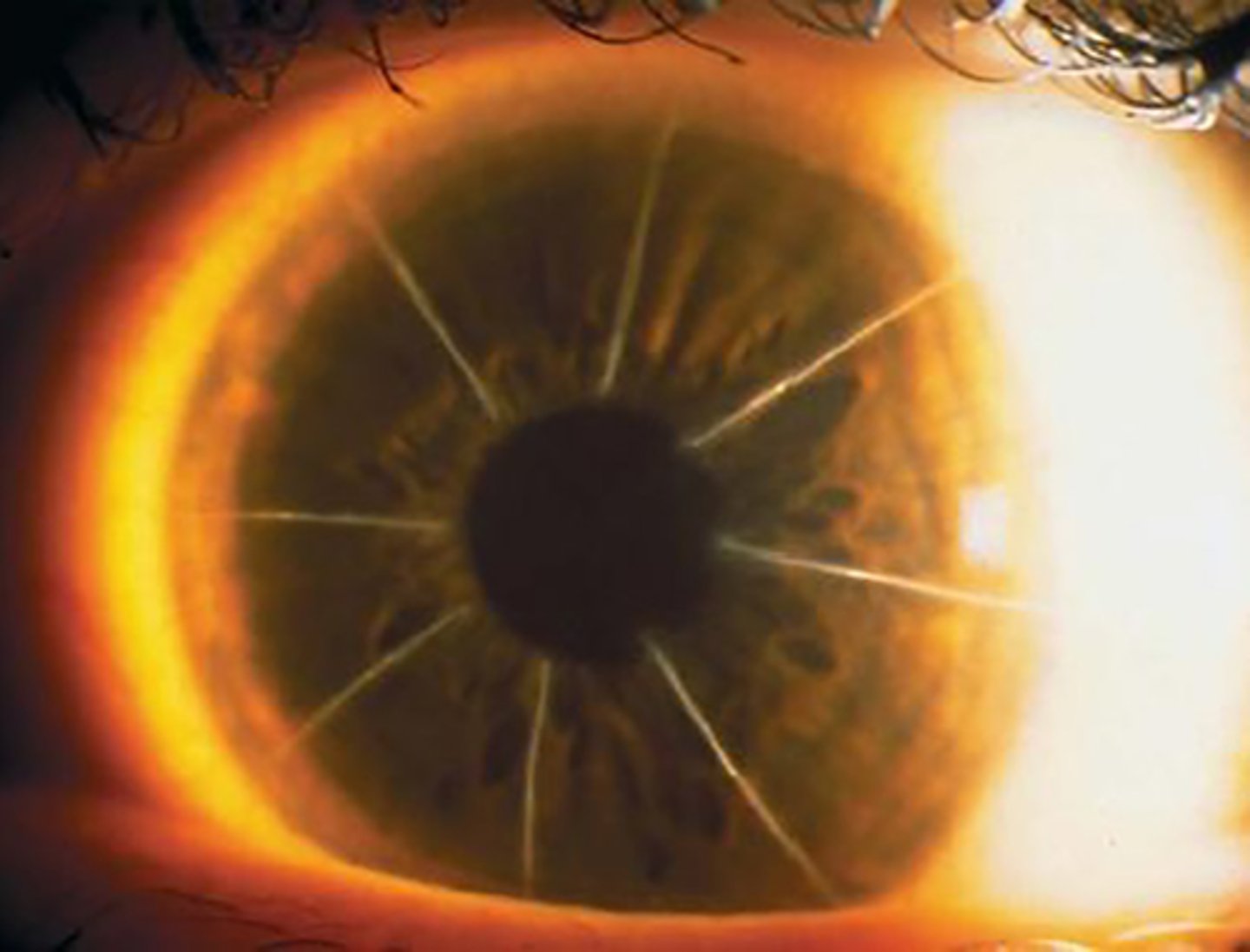 <p>Radial incisions cut into stroma to flatten the cornea</p>