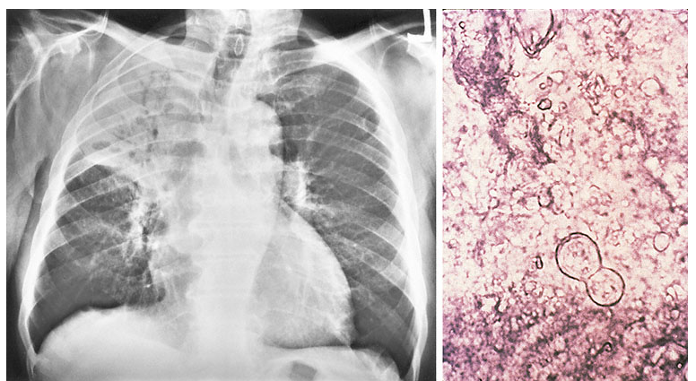 <p>27yo man w/hiv; 10-day hx of fever, chills, malaise, yellow sputum. CD4 = 24, high viral load.</p><p>broad-based budding, similar size as RBC</p>