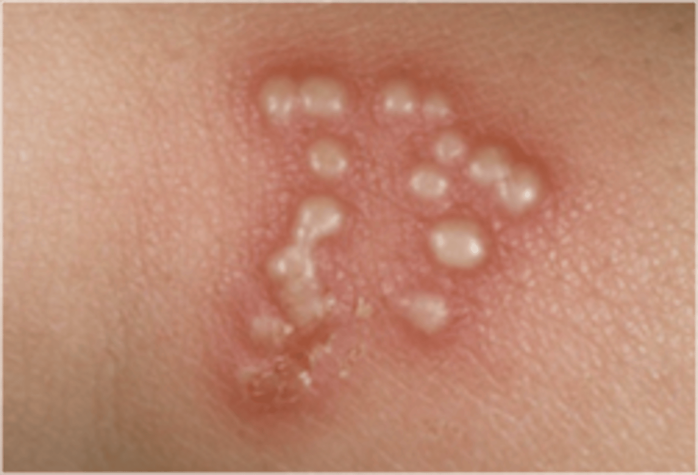 <p>Small circumscribed elevation of the epidermis containing clear fluid, &lt; 1 cm in diameter</p><p>- Ex: herpes simplex, herpes zoster, allergic contact dermatitis</p>