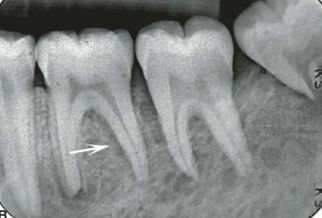 <p><strong>no expansion</strong>, ill defined patchy RL that can enlarge </p>
