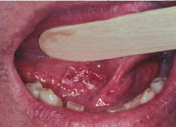 <p>risk of <span style="color: red;">premalignancy or malignancy</span> is higher than for homogenous leukoplakia</p><ul><li><p>a clinical diagnosis describing:</p><ul><li><p><strong>oral leukoplakia </strong>→ a <span style="color: red;"><span>red component</span></span>, or</p></li><li><p><strong>oral erythroplakia </strong>→ intermingled with<span style="color: red;"><span> white plaque</span></span></p></li></ul></li></ul><ul><li><p><strong>clinical studies show:</strong></p><ul><li><p>14% of lesions are invasive carcinoma</p></li><li><p>51% are epithelial dysplasia</p></li></ul></li></ul><ul><li><p><strong>treatment:</strong></p><ul><li><p>biopsy is essential</p></li><li><p>sample should include the red area for accurate diagnosis</p></li></ul></li></ul><p></p>