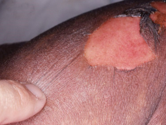 <p>what type of lesion is depicted</p>