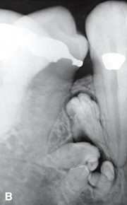 <p>tooth like structures with radiolucent rim, most likely diagnosis</p>