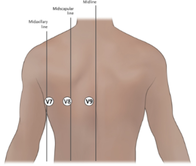 <ul><li><p>Sometimes a doctor will ask to have an EKG repeated using posterior leads</p></li></ul><ul><li><p>This can help to diagnose a particular type of heart attack (inferior wall myocardial infarction)</p></li></ul><p></p>