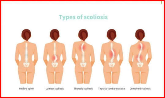<p>Câu 25: Tật vẹo cột sống tiếng Anh là gì?<span><span>&nbsp;</span></span></p><p class="MsoNormal">A. Scoliosis<span style="font-family: "Segoe UI Symbol", sans-serif;"><span>✓</span></span><span><span>&nbsp;</span></span></p><p class="MsoNormal">B. Kyphosis<span><span>&nbsp;</span></span></p><p class="MsoNormal">C. Lordosis<span><span>&nbsp;</span></span></p><p class="MsoNormal">D. Sway back<span><span>&nbsp;</span></span></p>