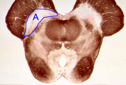 <p>Name the clinical condition when structure "A" is lesioned.</p>
