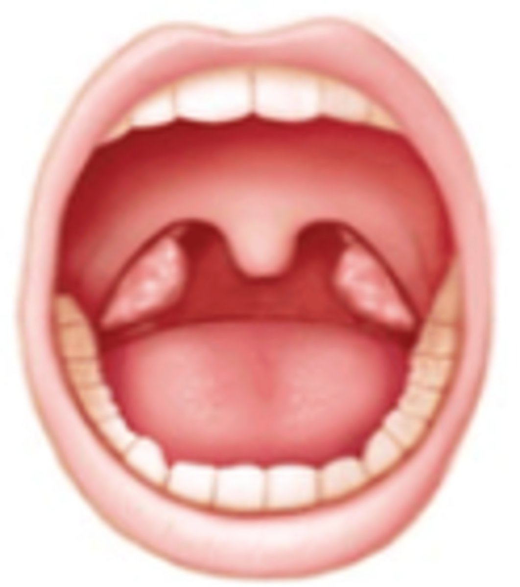 <p>which Brodsky grade:</p><p>Tonsils extending to the pillars</p>