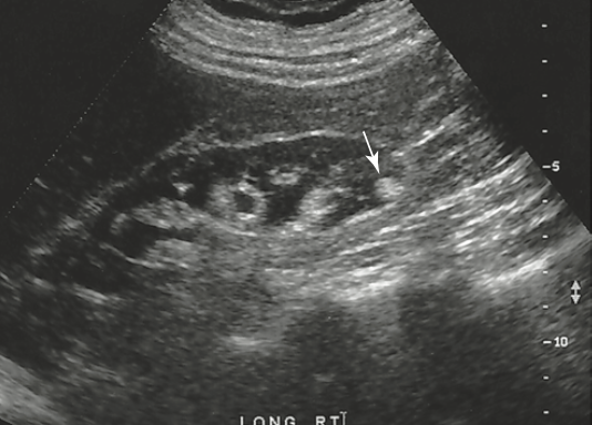 <p>a retroperitoneal ultrasound is ordered to follow up on a previously documents hydronephrosis of right kidney. The patient is presently asymptomatic. An image of right kidney demonstrates a small hyperechoic focus in the inferior pole, What is this most sus for</p>