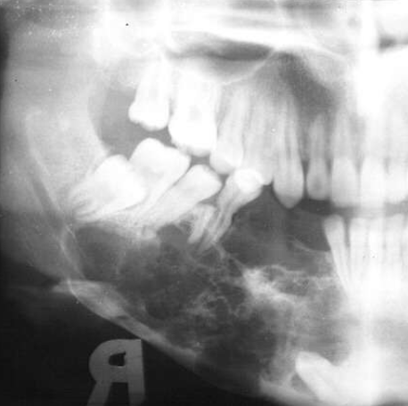<p>describe the ameloblastoma in this radiograph </p>