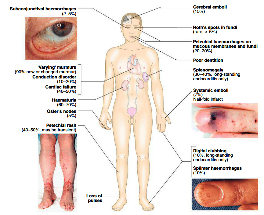 <ul><li><p>Suspected when patients with congenital or valvular heart diseases develop persistent fever, complains of unusual tiredness, night sweats or weight loss, or develops new signs of valve dysfunction or heart failure</p></li><li><p>May present as embolic stroke or peripheral arterial embolism</p></li><li><p>Purpura and petechiae</p></li><li><p>Splinter haemorrhages under fingernails or toenails</p></li><li><p>Osler’s nodes are painful, tender swellings at finger tips (sign of vasculitis)</p></li><li><p>Digital clubbing is a late sign</p></li><li><p>Spleen is frequently palpable</p></li><li><p>Coxiella infection: spleen and liver are enlarged</p></li><li><p>Non-visible hematuria</p></li></ul><p></p>