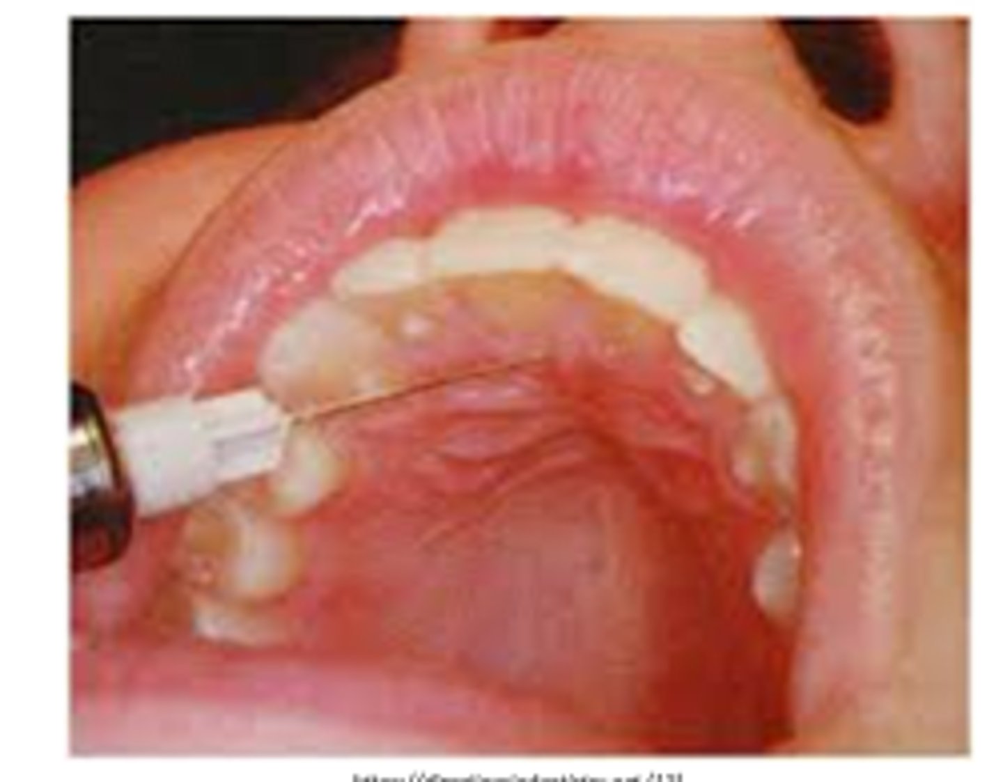 <p>• when treatment requires anesthesia of the lingual aspect of multiple anterior teeth</p>