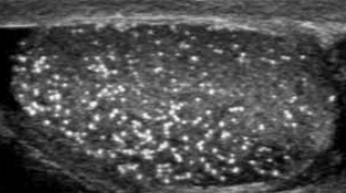 <p>tiny echogenic foci throughout testis; with or without shadowing</p>