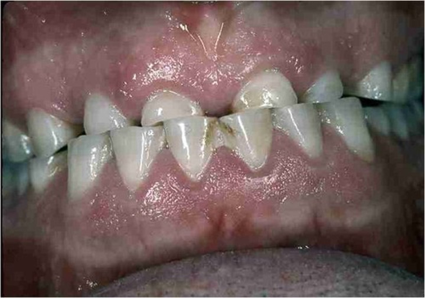 <p>wearing away of tooth structure during mastication, creating flattened occlusal, incisal, and interproximal surfaces </p><p>a more fibrous diet causes greater attrition </p><p>typically greater in MEN than women and in ELDERLY </p>