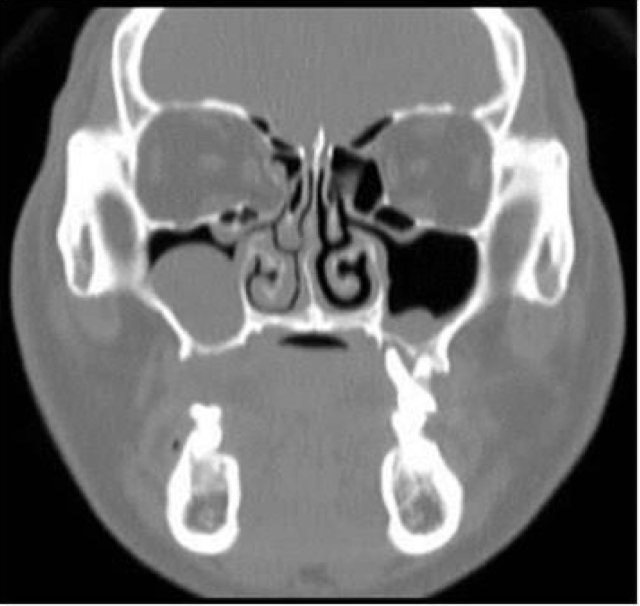 <p>An 18-year-old woman presented with unilateral rhinorrhea for past 2 months. She had a history of road accident 12 months months ago and trauma to the maxillary bone and was surgically fixed. Provide DD</p>