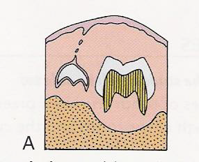 <p>Near the occlusal area of primary molars</p>