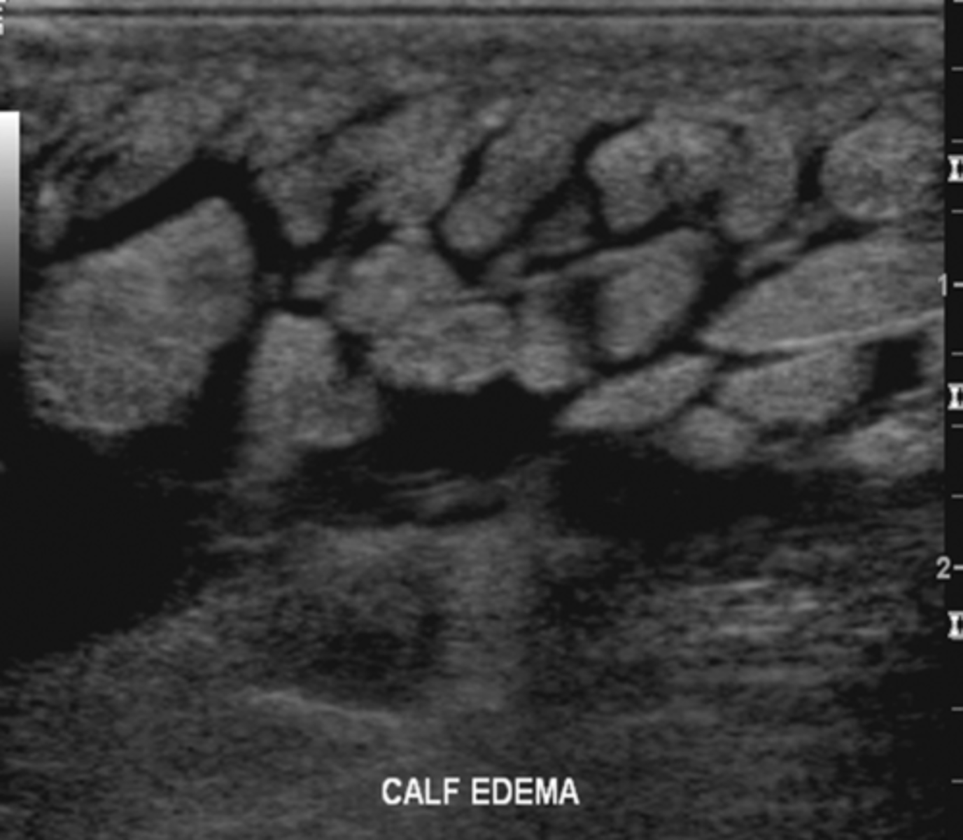 <p>Swelling due to an accumulation of lymph fluid around tissues</p>