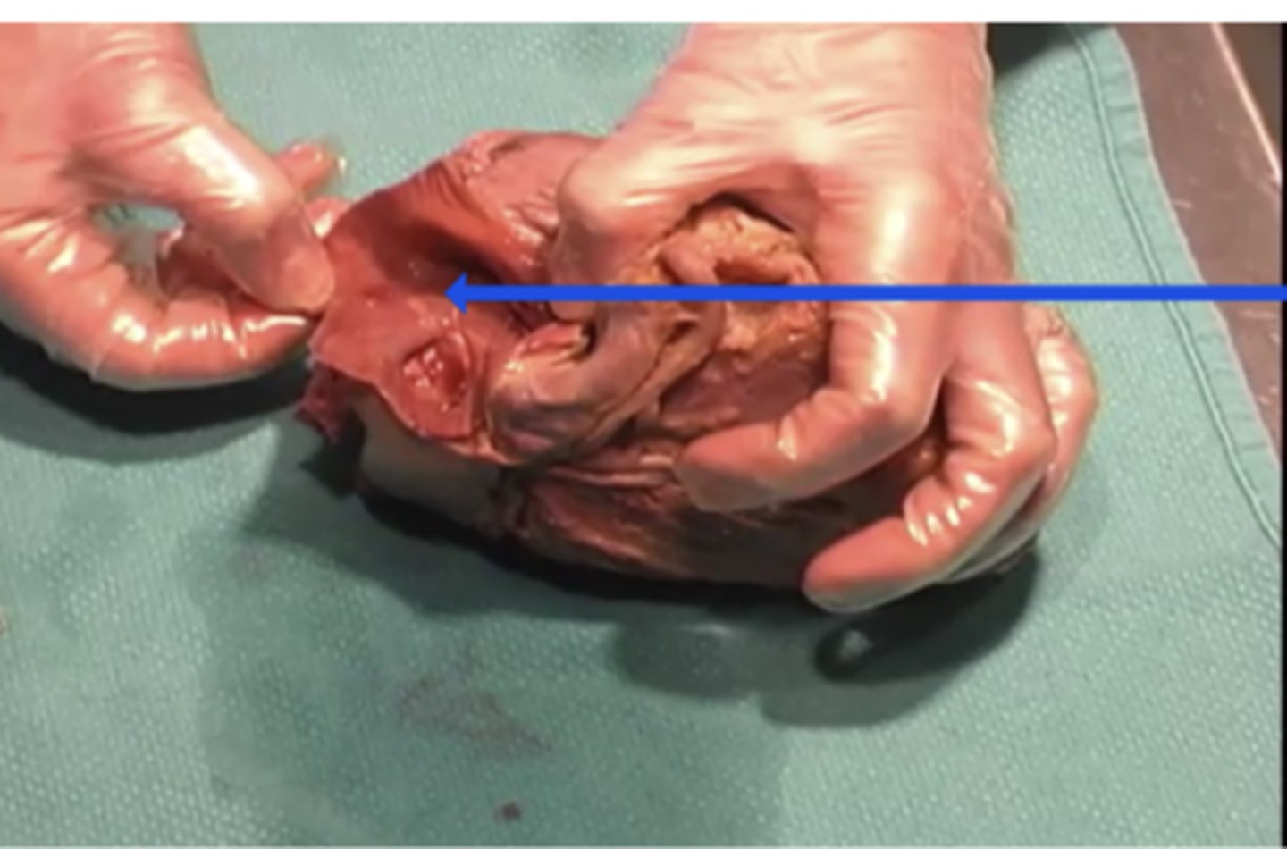 <p>To what structure is the arrow pointing?</p><p>aorta</p><p>superior vena cava</p><p>left atrium</p><p>right atrium</p>