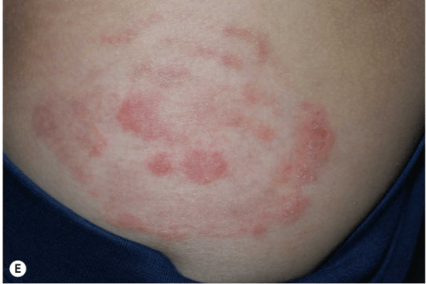 <p>Tinea Incognito</p>
