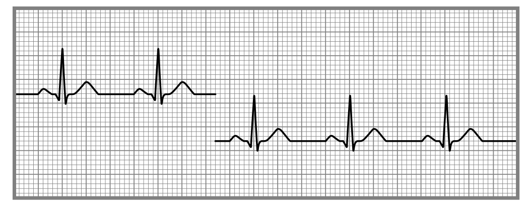 <p>an EKG artifact where the baseline is disrupted due to a loss of contact between the electrodes and the skin, often caused by movement or poor electrode placement. </p>