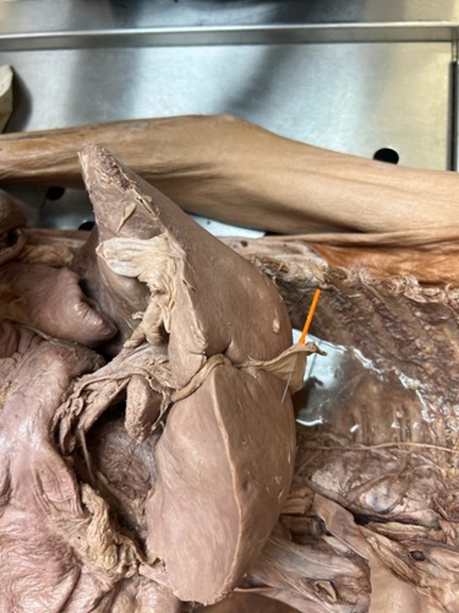 <p>falciform ligament</p>